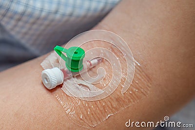 Catheter into the vein Stock Photo