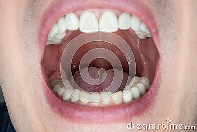 Caucasian male open oral cavity, close up shot Stock Photo