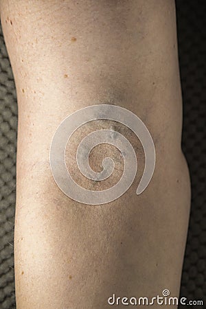 Caucasian woman have a varicose on inner side of arm Stock Photo