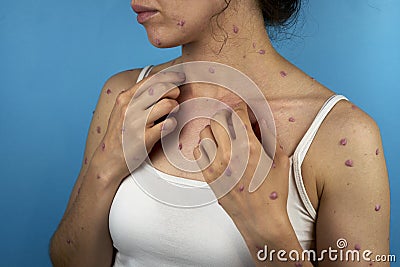 Causacian woman scratches red spots because of monkeypox Stock Photo