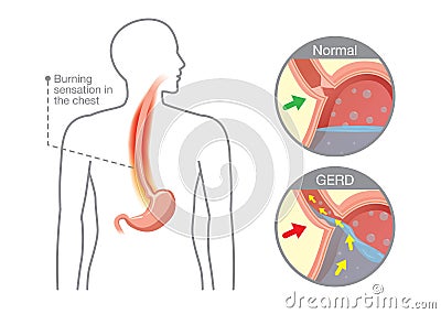 Cause of gastroesophageal reflux disease in human stomach Vector Illustration