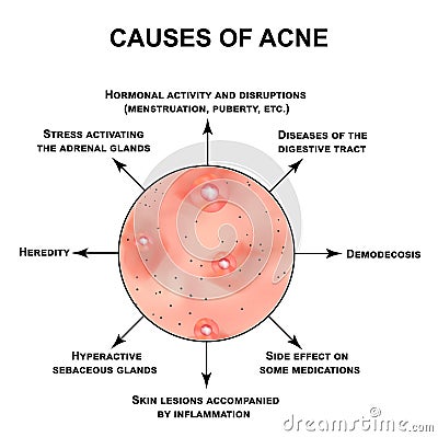 Causes of acne. Pustules, papules, comedones, blackheads, acne on the skin. Infographics. Vector illustration on Vector Illustration