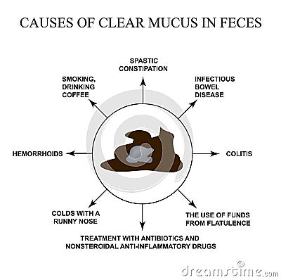 Causes of clear mucus in the feces. Diseases of the gastrointestinal tract. Infographics. Vector illustration on Vector Illustration