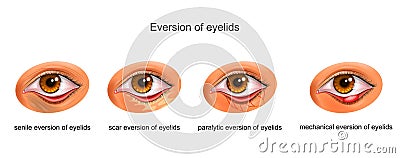 The causes of eversion of eyelids Vector Illustration