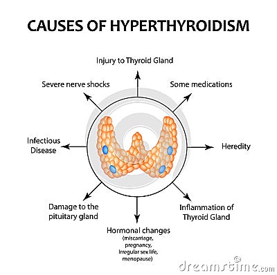 The causes of hyperthyroidism of the thyroid gland. Infographics. Vector illustration on background. Vector Illustration