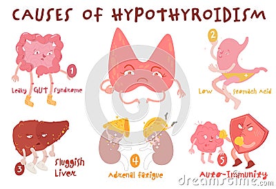 Causes of hypothyroidism thyroid gland disease. Endocrine system disorder. Medical vector illustration in cartoon style Vector Illustration