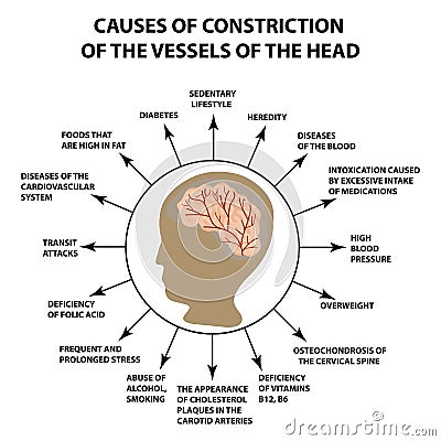 Causes of narrowing of cerebral vessels. World Stroke Day. Infographics. Vector illustration on isolated background Vector Illustration