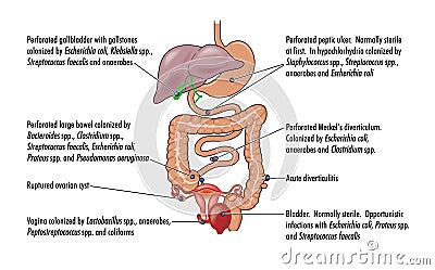 Causes of peritonitis Vector Illustration