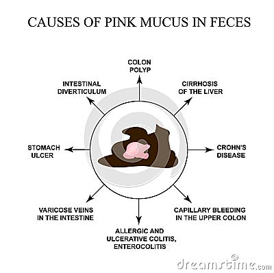 Causes of pink mucus in feces. Diseases of the gastrointestinal tract. Infographics. Vector illustration on isolated Vector Illustration