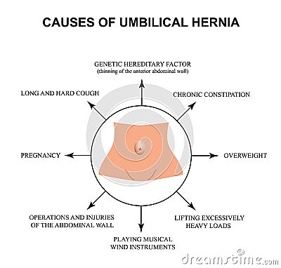 Causes of umbilical hernia. Infographics. Vector illustration on isolated background. Vector Illustration