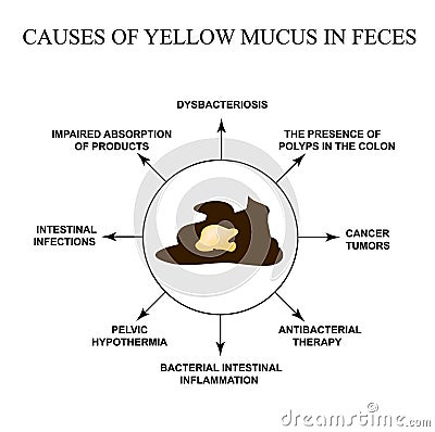 Causes of yellow mucus in feces. Diseases of the gastrointestinal tract. Infographics. Vector illustration on isolated Vector Illustration