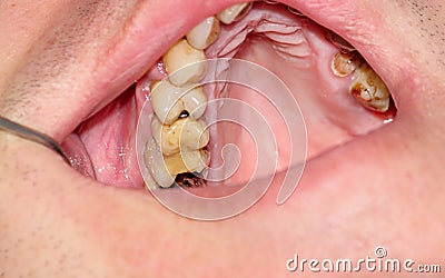 Cavities and old fillings in the upper teeth Stock Photo