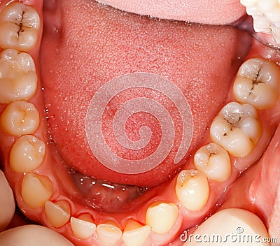 Cavity and teeth Stock Photo