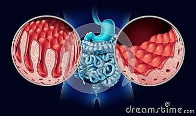 Celiac Coeliac Disease Cartoon Illustration