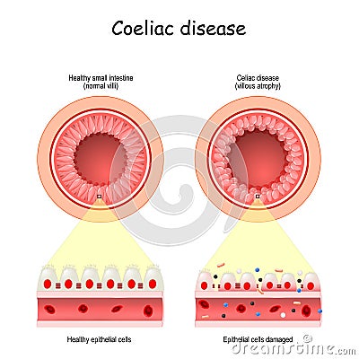 Celiac or Coeliac disease. leaky gut Vector Illustration