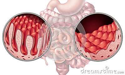 Celiac Coeliac Intestine Disease Cartoon Illustration