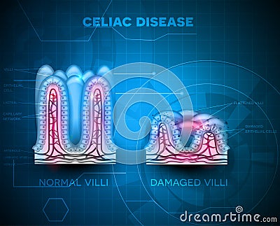 Celiac disease Vector Illustration