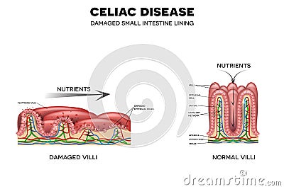 Celiac disease Vector Illustration