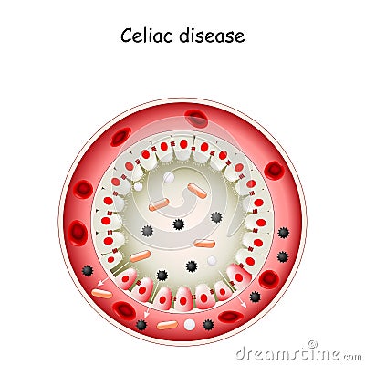 Celiac disease. Cross section of Small intestine Vector Illustration