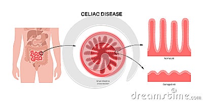 Celiac disease inflammation Vector Illustration