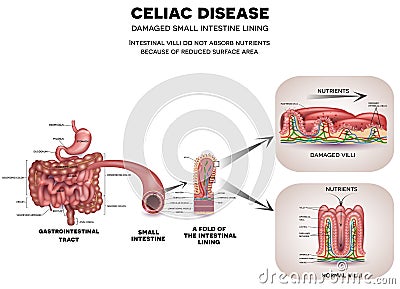 Celiac disease Vector Illustration