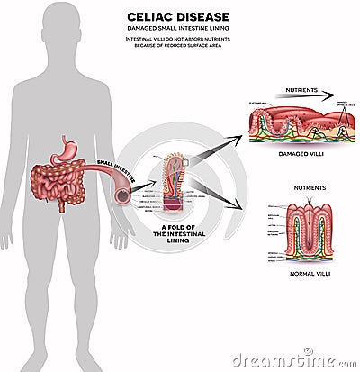 Celiac disease info poster Vector Illustration