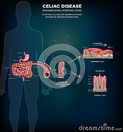 Celiac disease info poster Vector Illustration