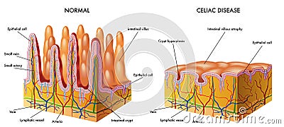 Celiac disease Vector Illustration