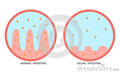 Celiac disease Small intestine lining damage. good and damaged villi . leaky gut progression Vector Illustration
