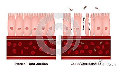 Celiac disease Small intestine lining damage. good and damaged villi . leaky gut progression Vector Illustration