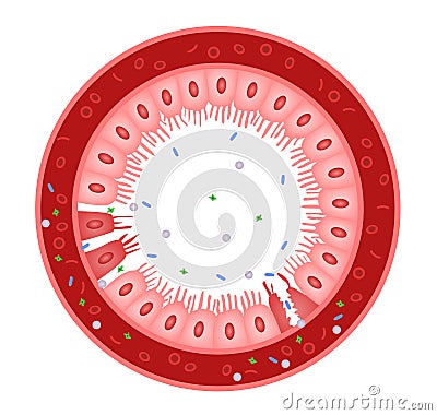 Celiac disease Small intestine lining damage. good and damaged villi . leaky gut progression Vector Illustration