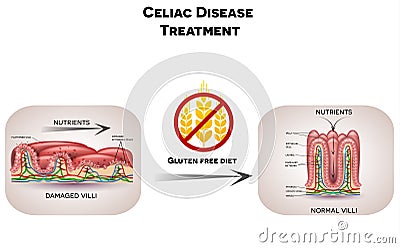 Celiac Disease Treatment Gluten Free Diet Stock Vector ...