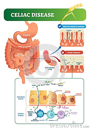 Celiac disease vector illustration. Labeled diagram with its structure Vector Illustration