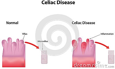 Celiac Disease Vector Illustration