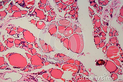 Human thyroid gland with goiter caused by deficiency of iodine under a microscope Stock Photo