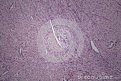 Cells of human uterus tissue with inoffensive tumor cells Stock Photo