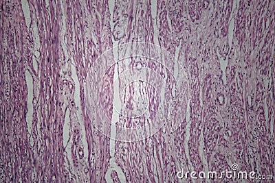 Cells of human uterus tissue with inoffensive tumor cells Stock Photo