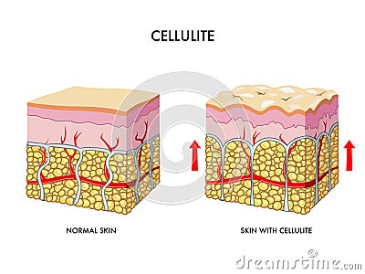 Cellulite Vector Illustration