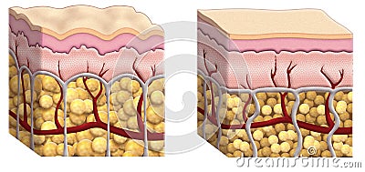 Cellulite cross section Stock Photo