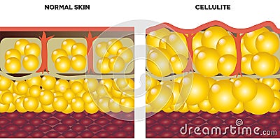 Cellulite and normal skin Vector Illustration