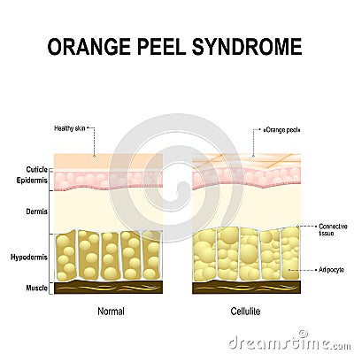 Cellulite or orange peel syndrome Vector Illustration