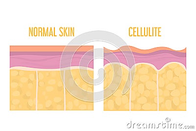 Cellulite skin and healthy skin anatomy. Fat tissue of human body Cartoon Illustration