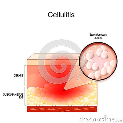 Cellulitis. layers of the human Skin. Close-up of Staphylococcus aureus Vector Illustration