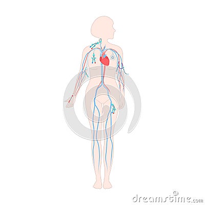 Central line venous catheter types on female body Vector Illustration