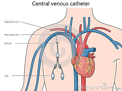 Central venous catheter structure medical science Cartoon Illustration