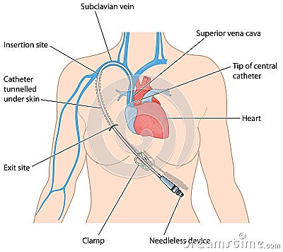 Central venous catheter in subclavian vein Vector Illustration