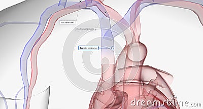 A central venous catheter is a thin, flexible tube inserted into one of the body's major veins Stock Photo