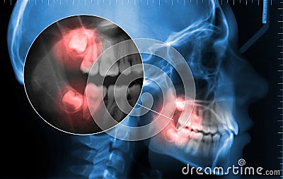 Cephalometric and displaying toothache zoom Stock Photo