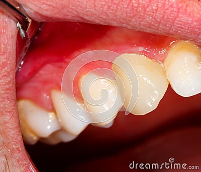 Ceramic crown on tooth Stock Photo