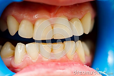 Ceramic crown with zirconia base Stock Photo